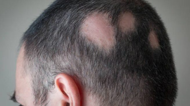 tratar la alopecia areata