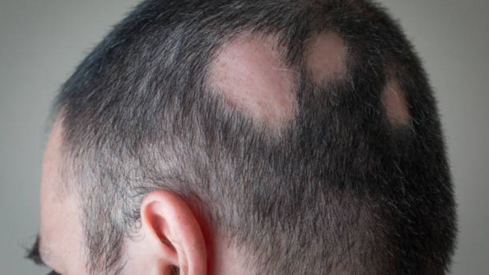 Cómo tratar la alopecia areata con remedios naturales paso a