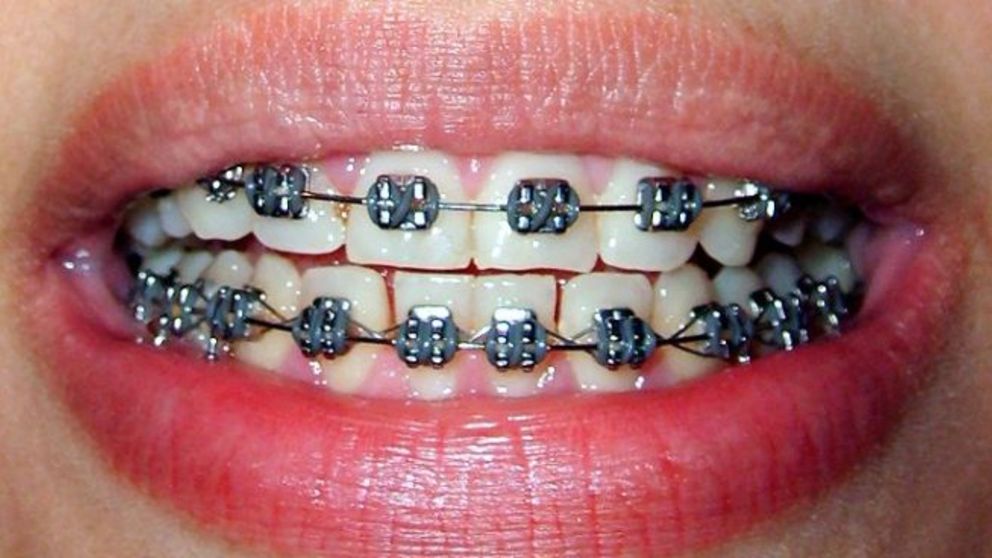 Cómo cepillarse los dientes cuando llevas brackets de forma correcta paso a paso
