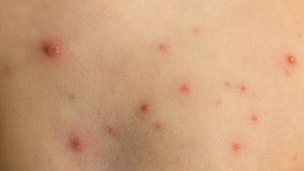 eliminar las cicatrices de la varicela