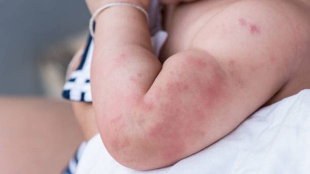 Eritema tóxico en la piel del bebé: Qué es y cuál es la causa