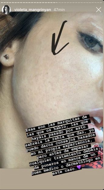 Violeta Mangriñán muestra la realidad de su piel en Instagram