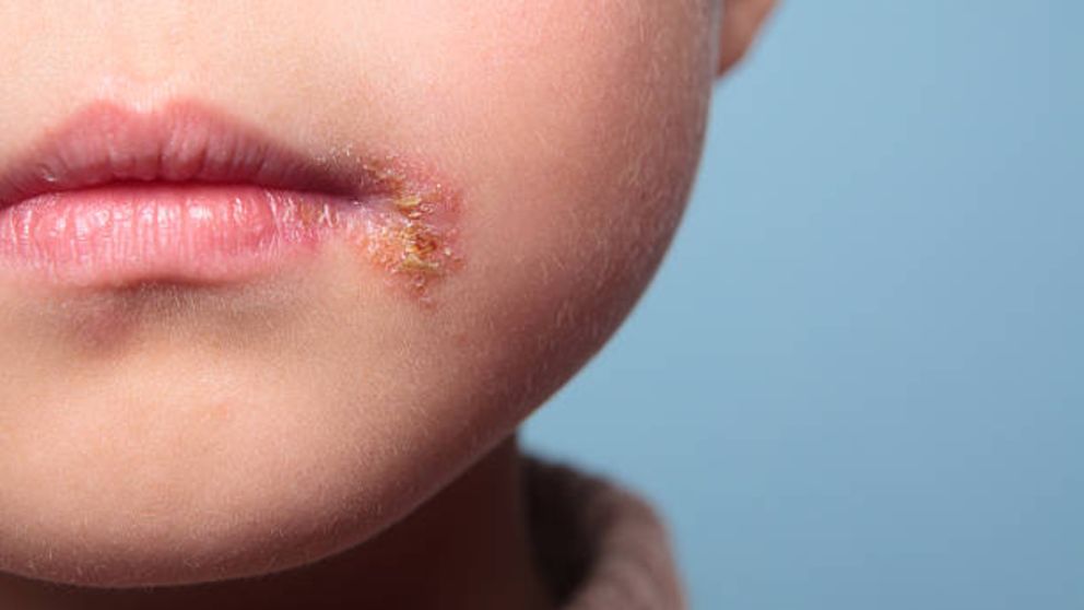 Descubre qué es el herpes labial en niños y cómo tratar