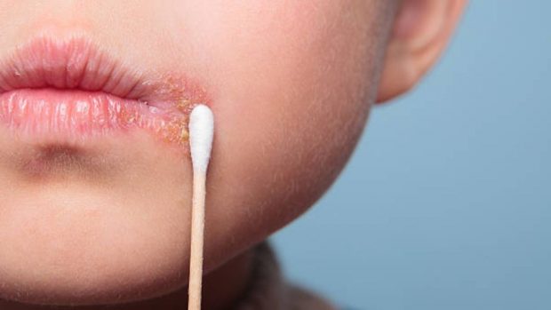 Herpes labial en niños: Causas y tratamiento