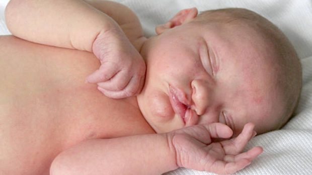 Labio leporino en el bebé, ¿se puede prevenir"