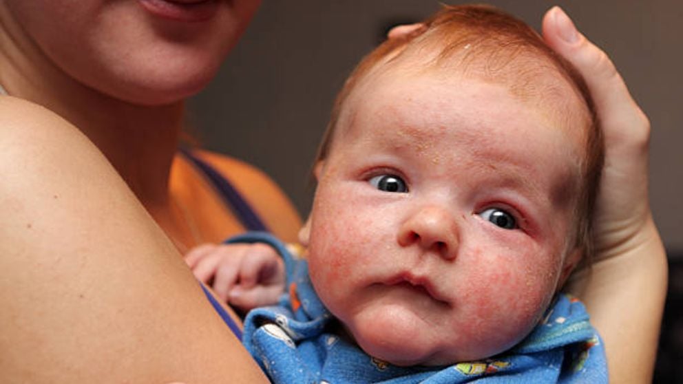 Descubre qué es y cómo tratar la anafilaxia en bebés y niños