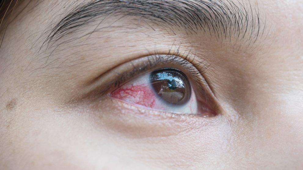 Prevención de las manchas rojas en los ojos
