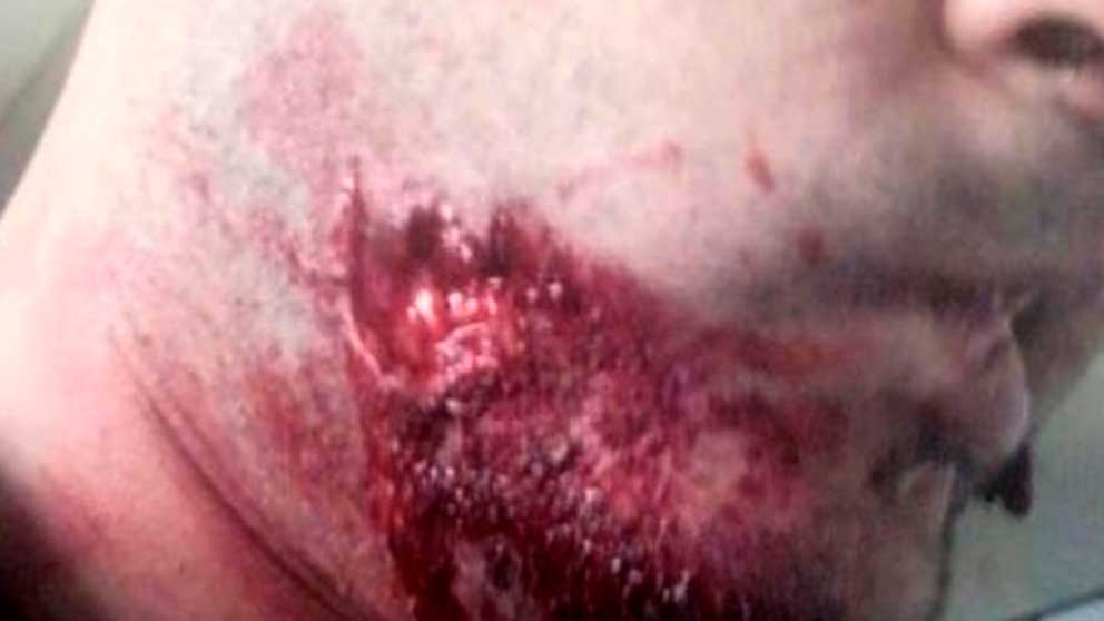 Una de las heridas provocadas por el salvaje agresor que ha mordido a un vigilante de seguridad del Metro de Barcelona,