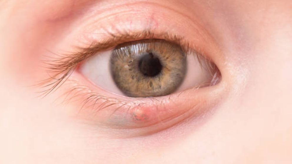 imágenes de infección ocular por chalazión