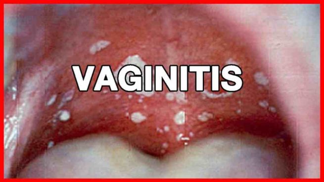 Todo sobre la vaginitis atrófica