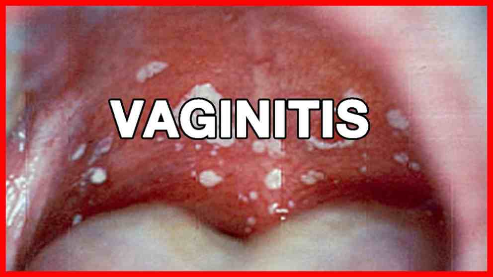 ¿En qué consiste la vaginitis atrófica?