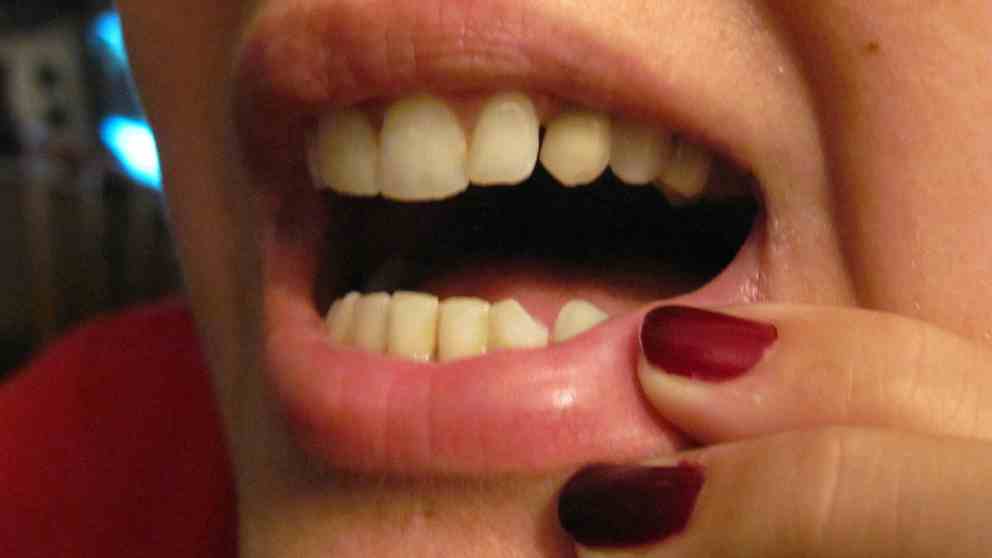 Cómo tratar las heridas en la boca