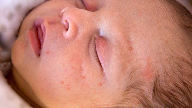 Acné neonatal: Causas y remedios para el acné del bebé