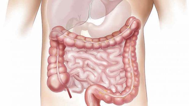 Invaginación intestinal