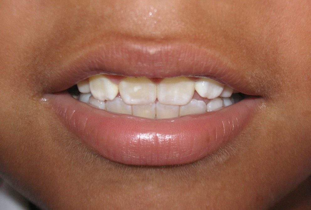 Manchas en dientes: la fluorosis