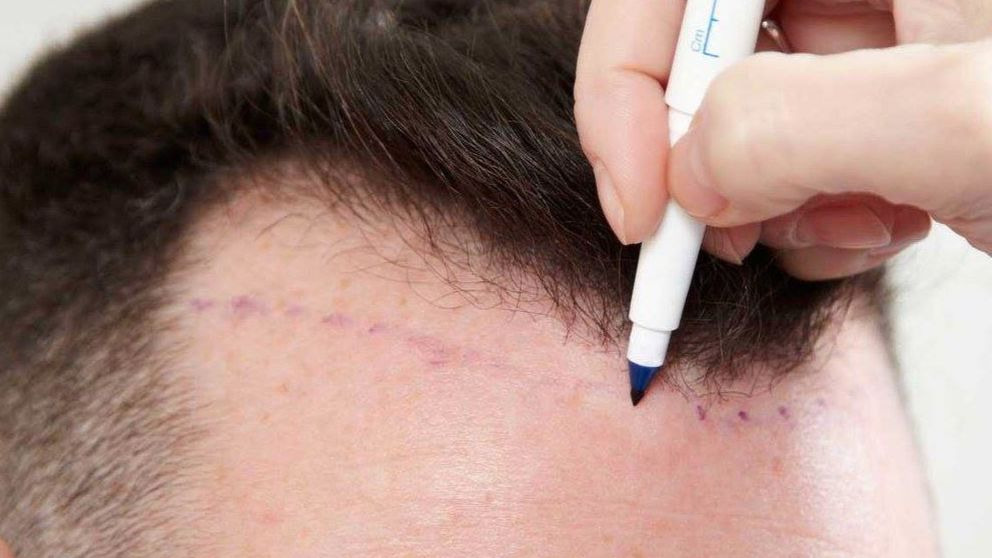 3 mentiras del transplante capilar que no debes creerte