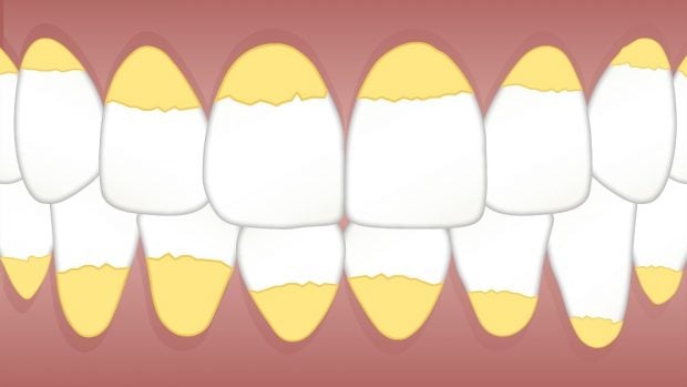 El sarro en dientes