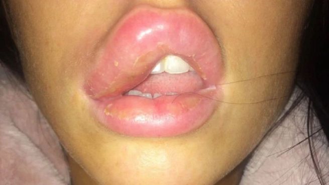 Relleno de labios: una joven casi se queda ciega