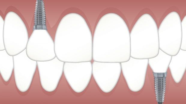 El implante dental
