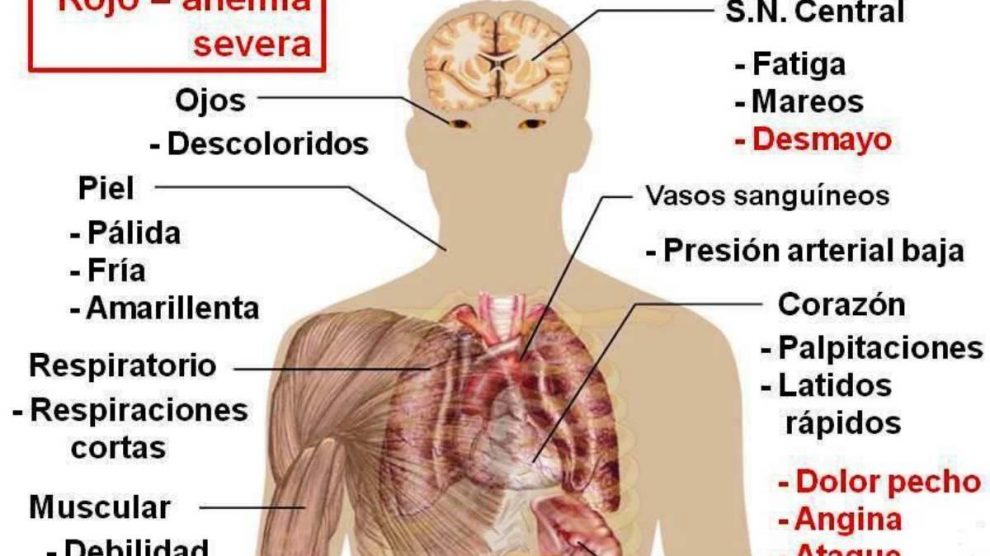 ¿Qué es la anemia de células falciformes?