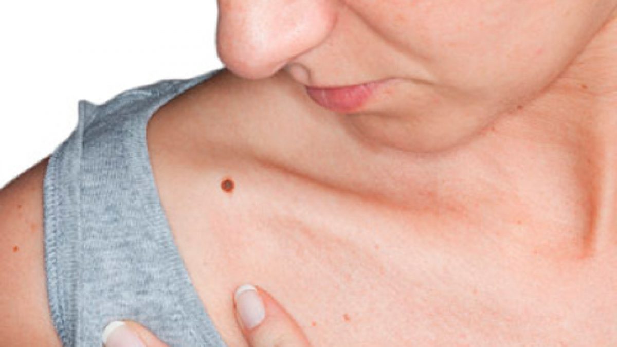 Los lunares pueden ser un aviso de un cáncer de piel