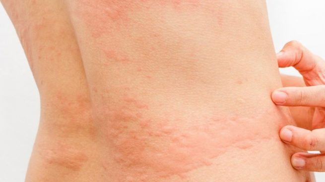 Cuáles son los efectos del coronavirus en la piel