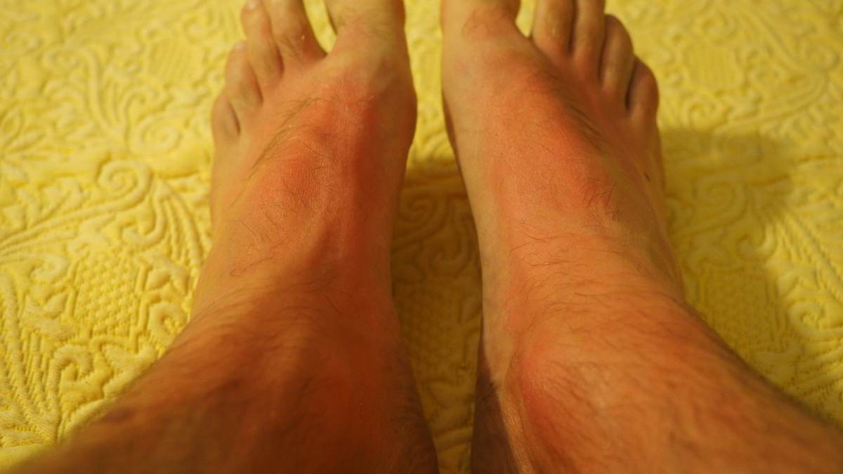 Erupciones en pies y manos, ¿posibles síntomas de coronavirus?