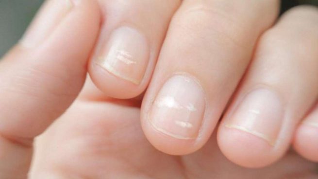 manchas y líneas blancas en las uñas