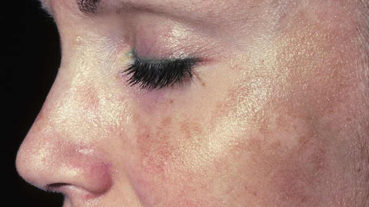 Enfermedades de la piel: el melasma