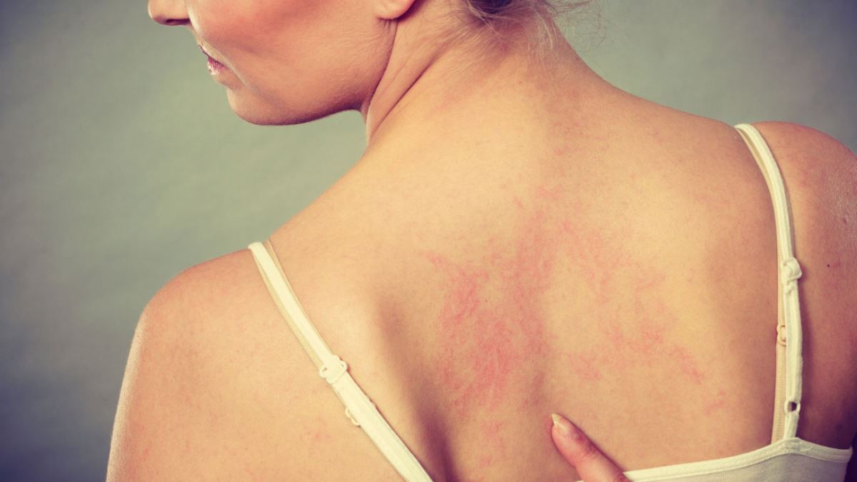 La piel puede sufrir diversas lesiones a causa del coronavirus
