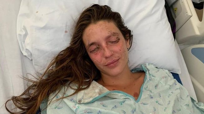 Marta, la joven española que se quemó con sosa cáustica en EE.UU, recuperará la vista