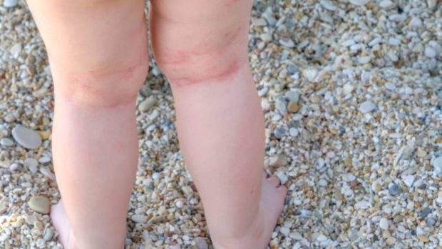 Alergia al sudor en niños: cómo se manifiesta y cómo tratar