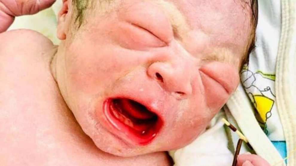 El bebé recién nacido con el DIU de su madre en la mano