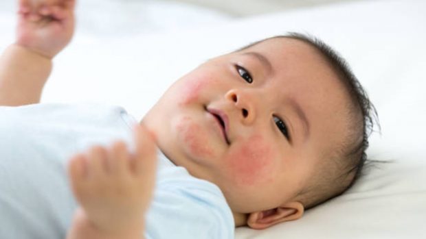 bebés alergias