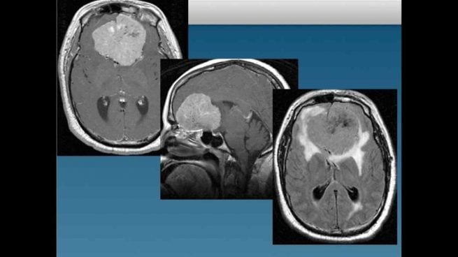 Tumor en el cerebro