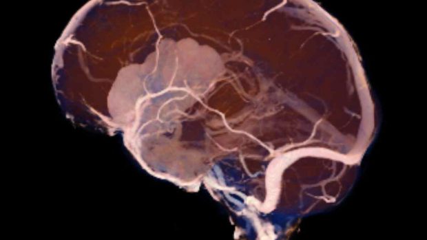 Tumor en el cerebro