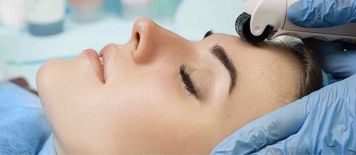 ¿En qué consiste el microneedling?