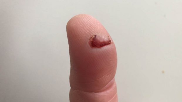 Dedo con herida