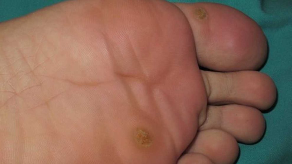 Cómo tratar un papiloma en el pie