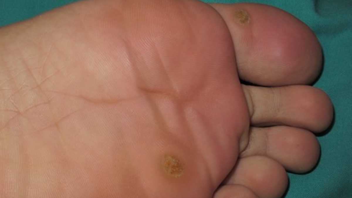 Nucșoară varicele tinctură, Virus del papiloma humano verrugas en el pie