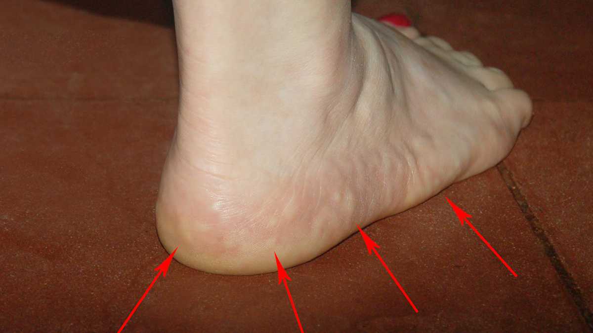 Tratamiento de un papiloma en el pie