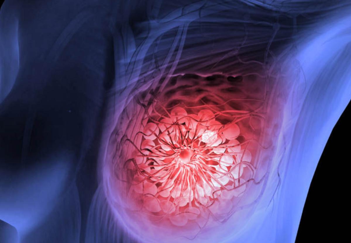 Nueva investigación para tratar de vencer al cáncer de mama.