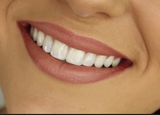 Por qué se oscurecen los dientes y qué hacer para blanquearlos