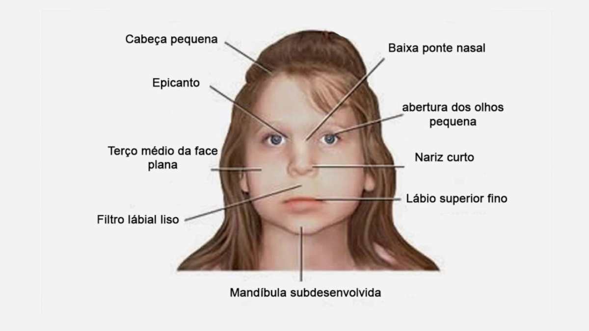 La lisencefalia