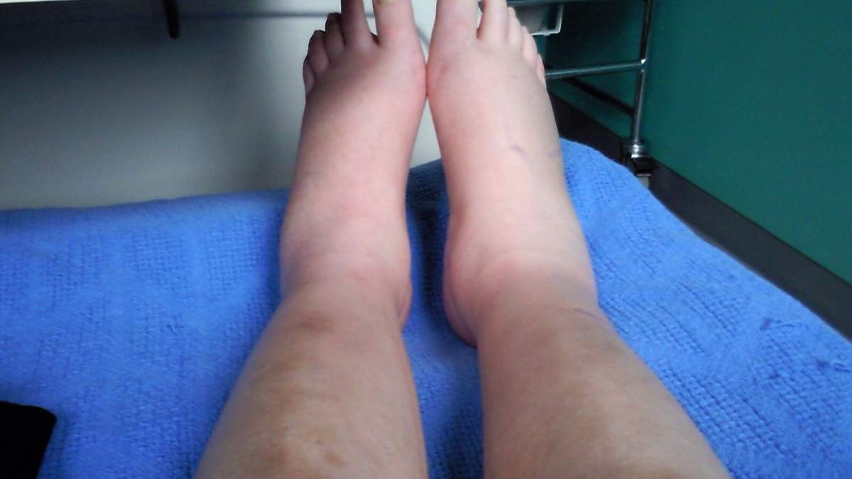 ¿Qué es un edema óseo y cómo hay que tratarlo?