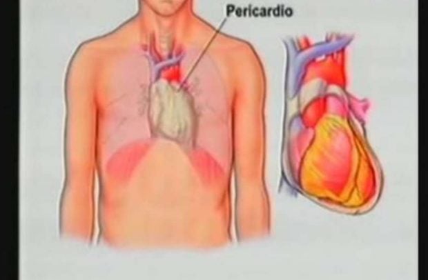 Https Okdiario Com Img 2020 11 26 Pericarditis Que Es Sintomas Causas Y Tratamientos De Esta Enfermedad 2 620x406 Jpg [ 406 x 620 Pixel ]