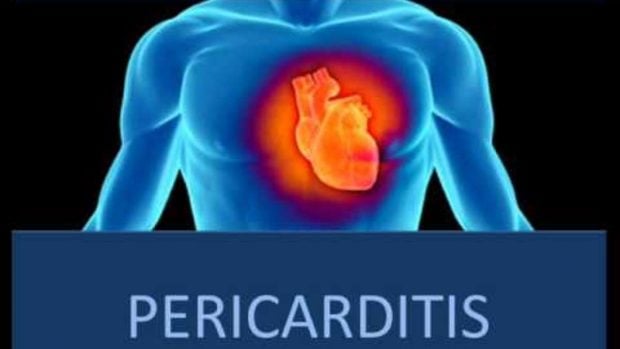 Pericarditis