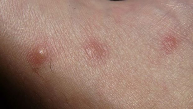 La dermatitis atópica, una patología que empeora con el frío