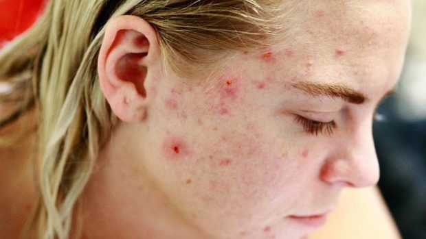 ¿Qué es el acné y por qué aparece?