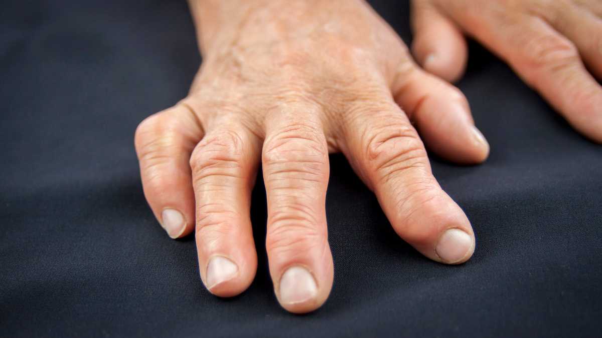 Артрит мягких тканей пальцы